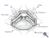 Neue OP-Technik mit Kunststoffnetzen (Großes Bild in neuem Fenster)
