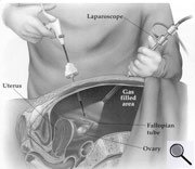 Schematische Abbildung einer Laparoskopie (Großes Bild in neuem Fenster)
