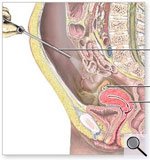 Schematische Querschnitt-Abbildung einer Laparoskopie (Großes Bild in neuem Fenster)